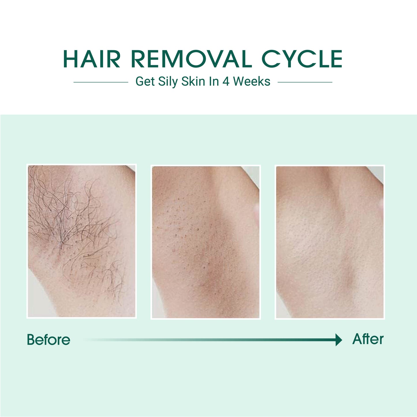 Laser IPL Hair Removal - Marilyn's Marketplace
