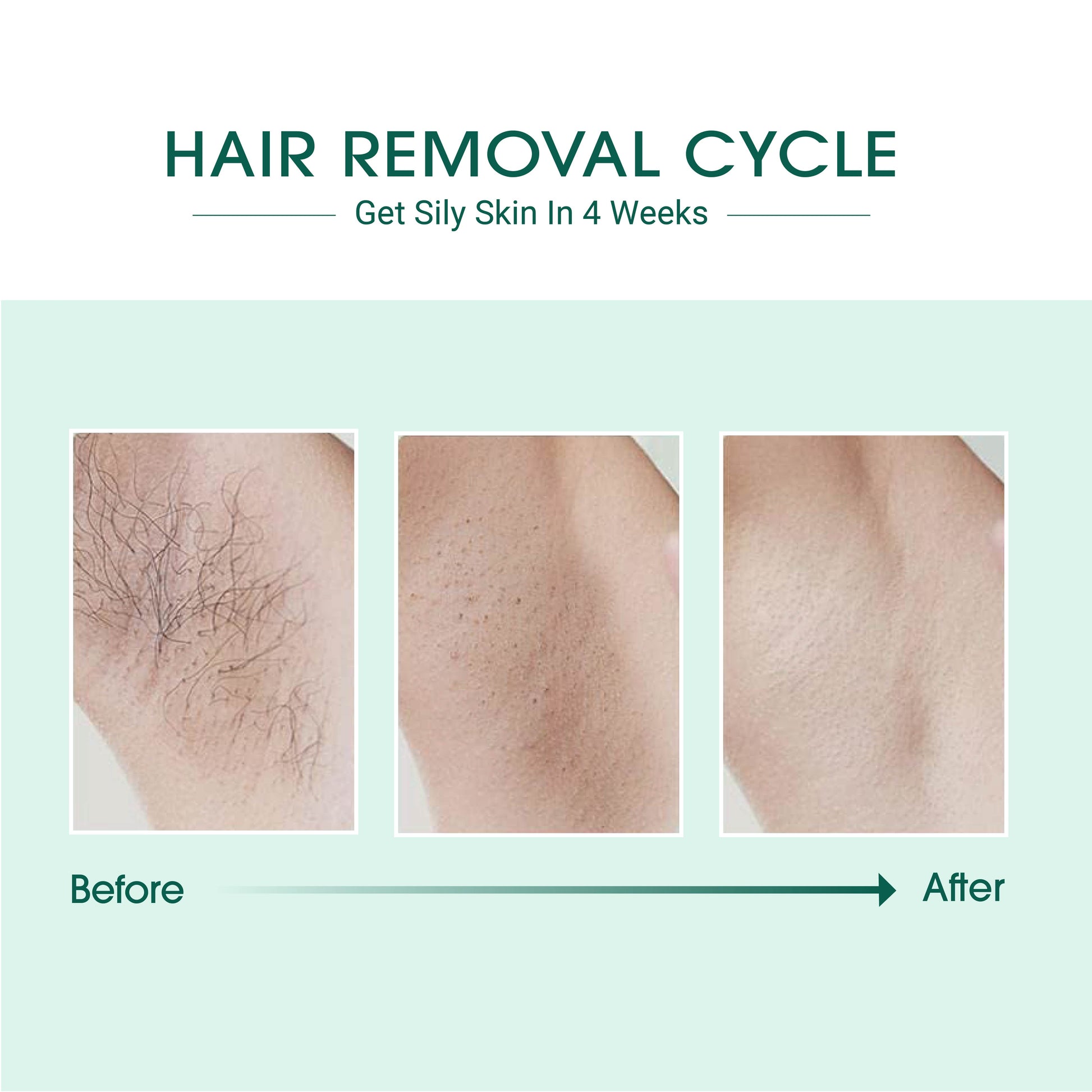 Laser IPL Hair Removal - Marilyn's Marketplace